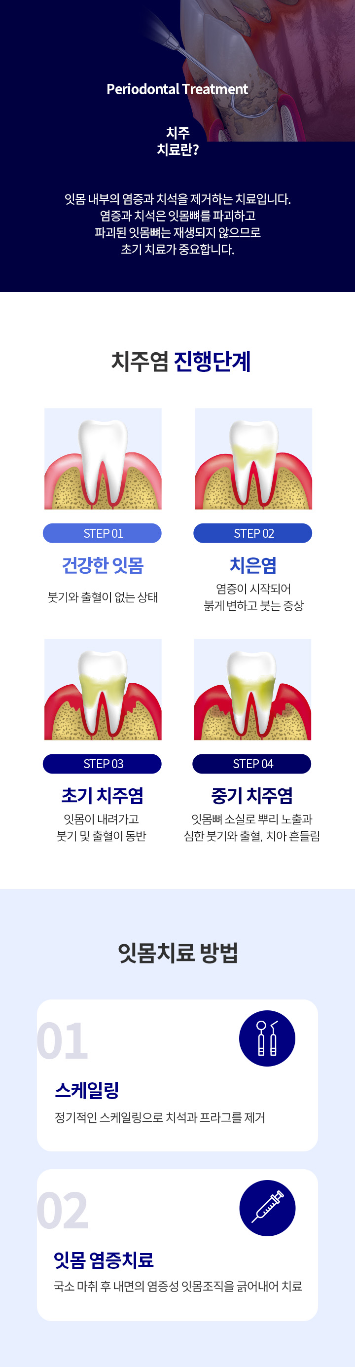 자연치아 살리기_4_치주치료