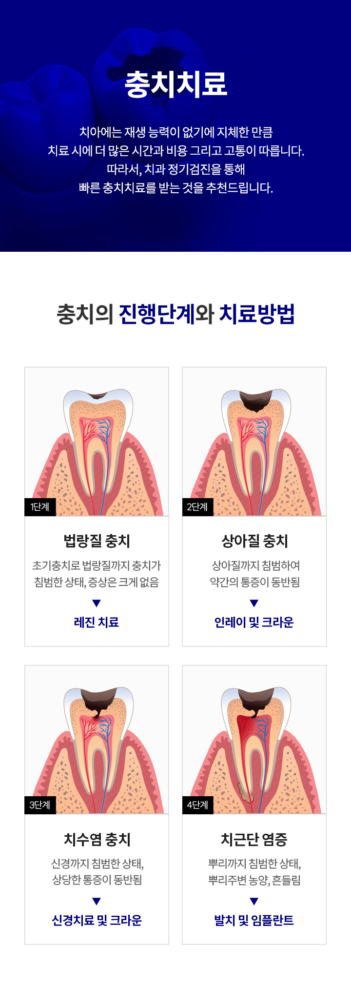 자연치아 살리기_5_충치치료