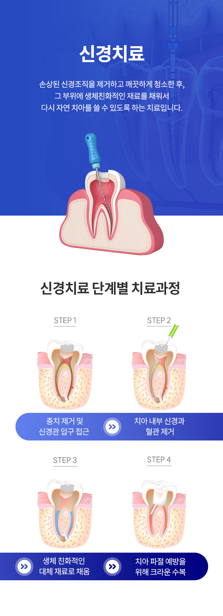 자연치아 살리기_6_신경치료