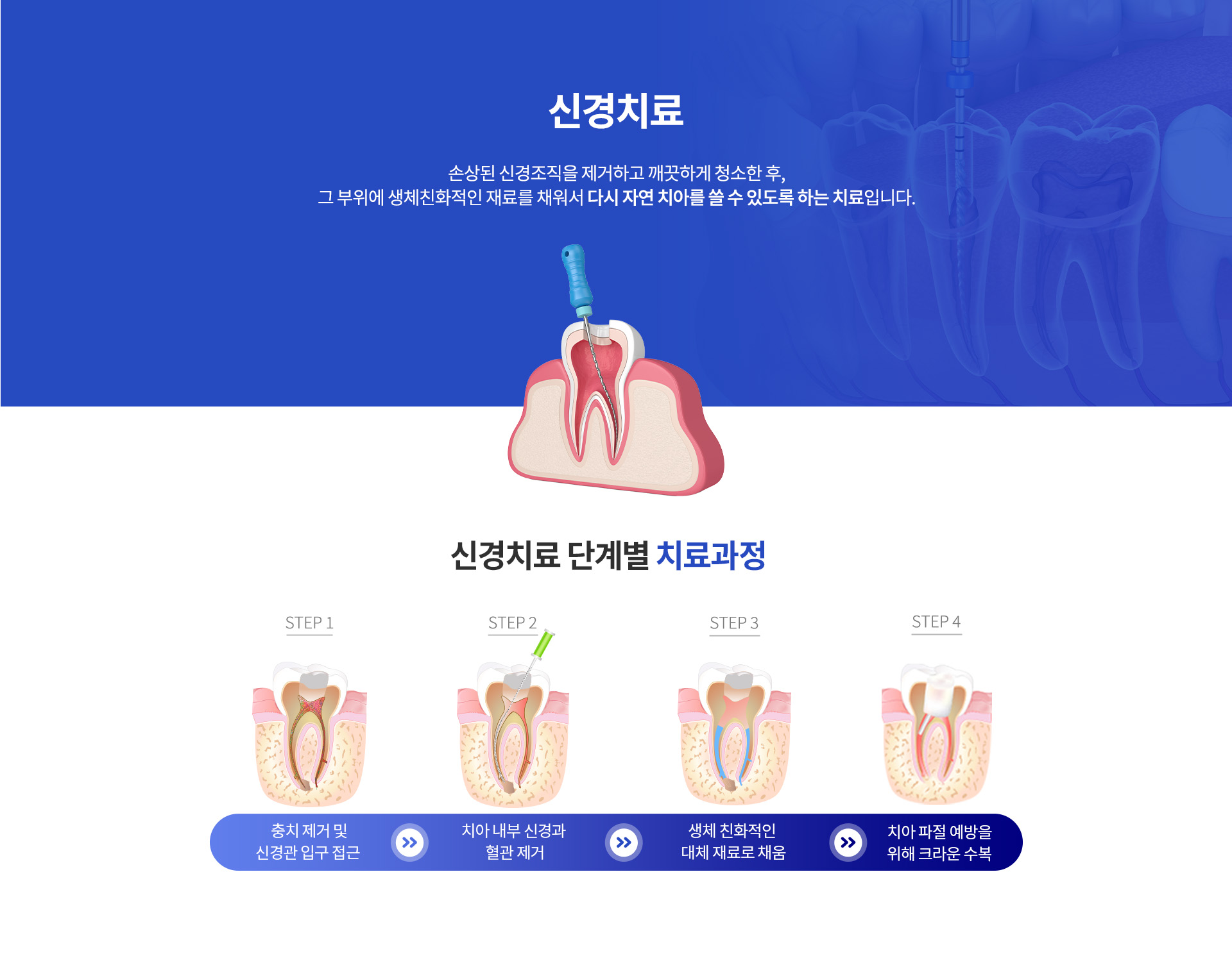 03_자연치아 살리기_6_신경치료