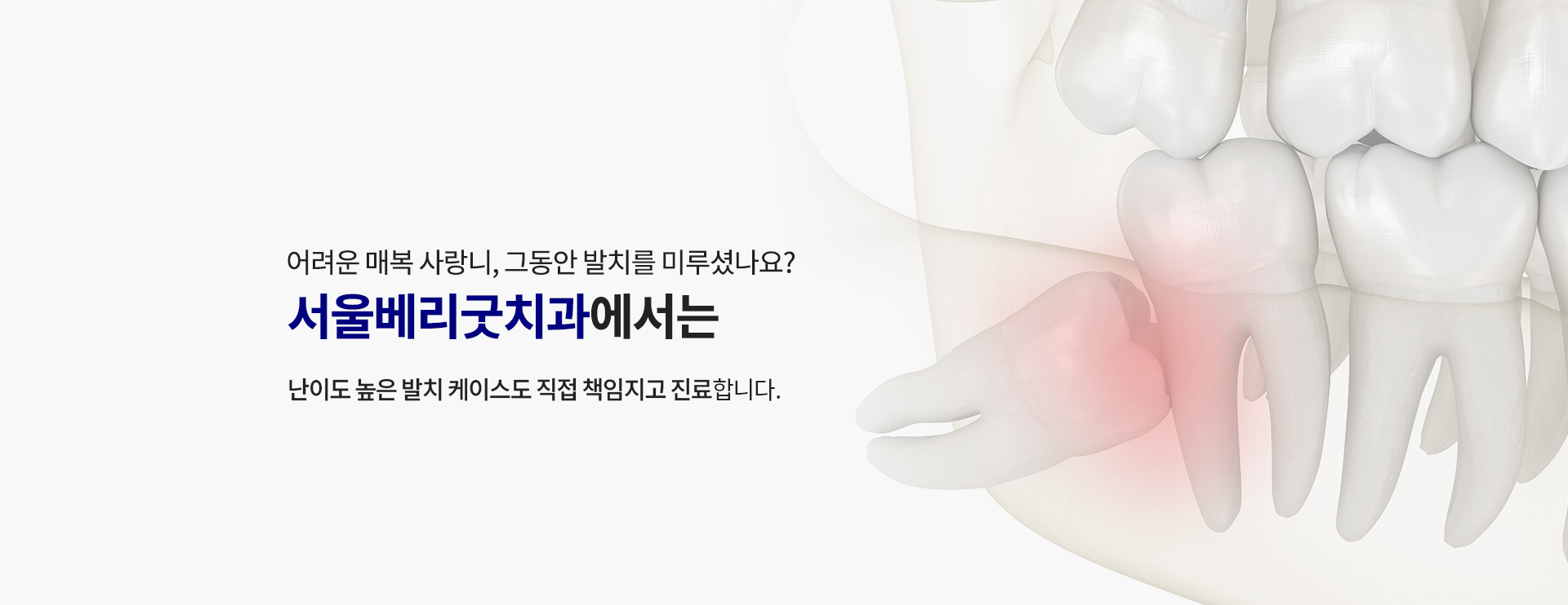 04_사랑니 발치_2_사랑니