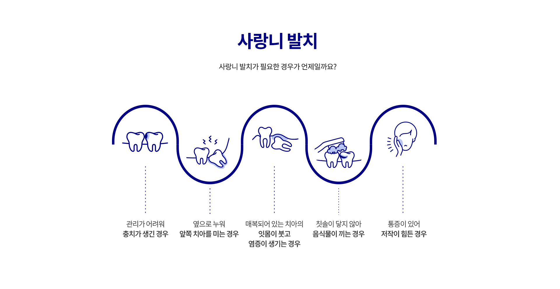 04_사랑니 발치_3_사랑니 발치